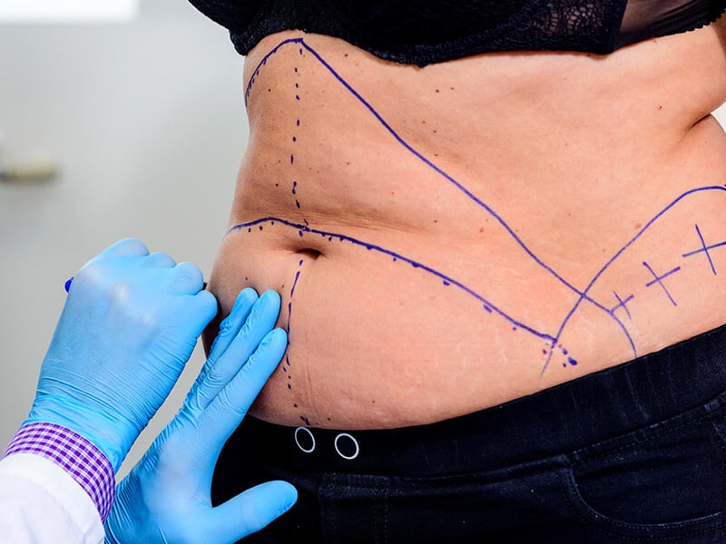 Abdominoplastia