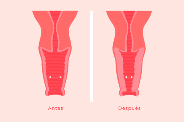 Rejuvenecimiento Vaginal